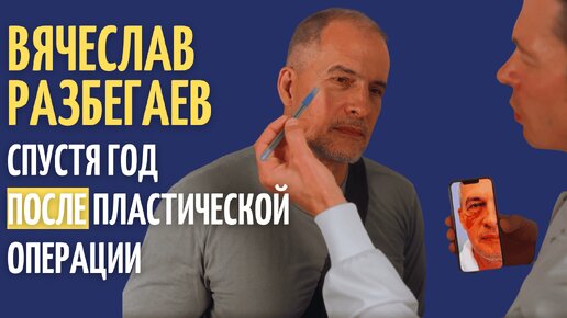 Вячеслав Разбегаев: отзывы о липофилинге и блефаропластике спустя год после операции!