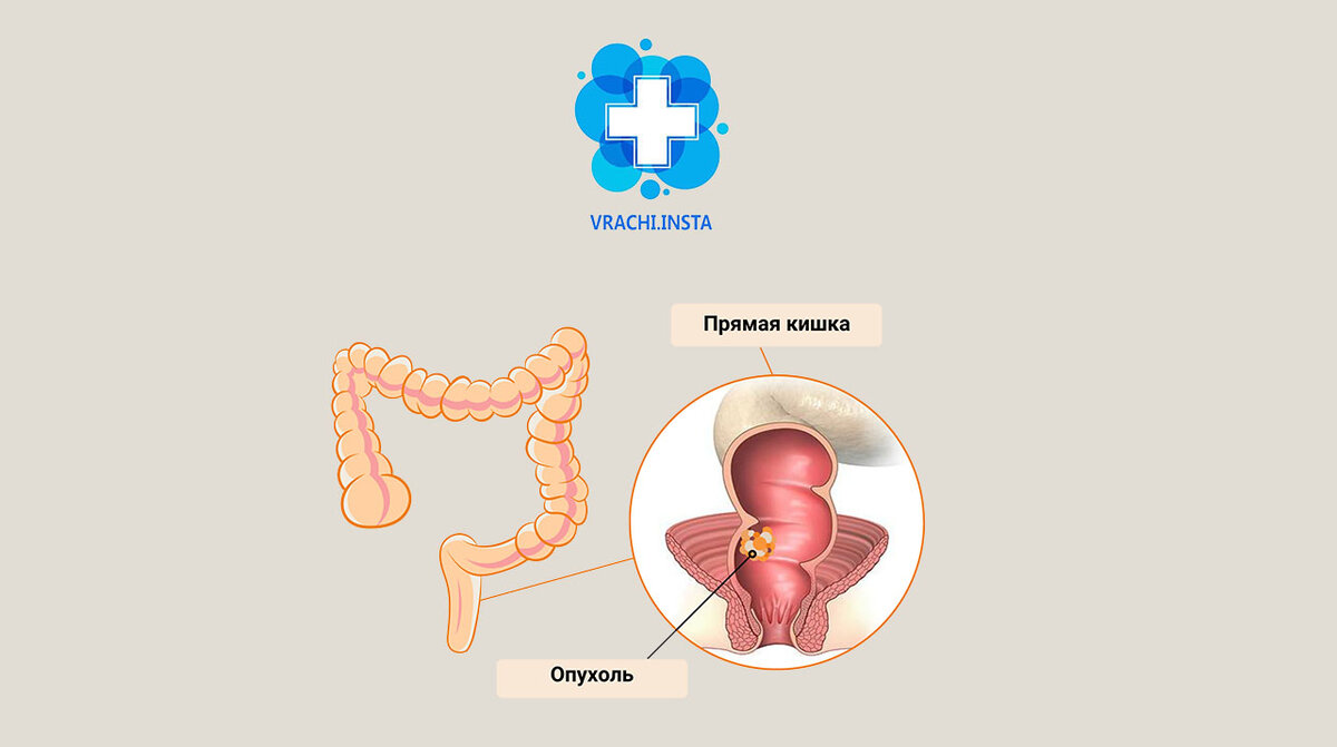 Краткая анатомия геморроя