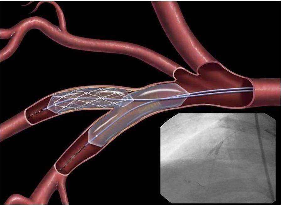 Коронарный стент. Операция стентирование сосудов сердца. Стентирование сосудов эндоваскулярное. Баллонная ангиопластика сосудов сердца. Баллонная ангиопластика сосудов нижних конечностей.