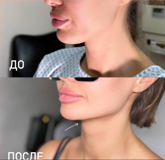    Виктория Боня сделала пластику подбородка более полугода назадСоцсети Виктории Бони