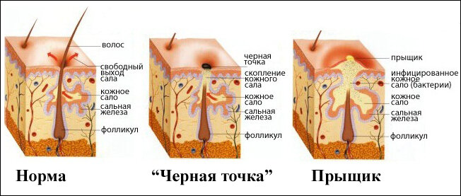 КАК УМЕНЬШИТЬ ПОЯВЛЕНИЕ ЧЕРНЫХ ТОЧЕК