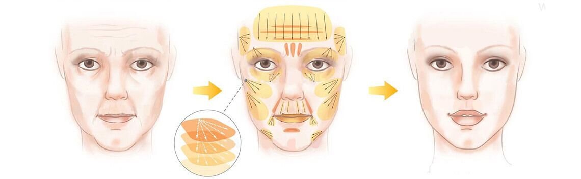 липофилинг контурная пластика. липофилинг лица (контурная пластика). липофилинг зоны. липофилинг подбровной области. липофилинг зоны.