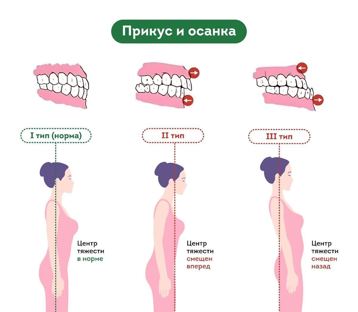 Смещение центра тяжести позвоночника человека с дефектами прикуса.