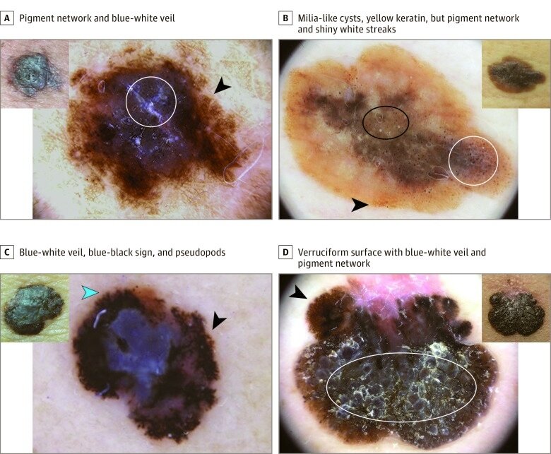 Четыре меланомы, имитирующие себорейный кератоз (СК), принадлежат к группе из 110 образований, которые можно легко обнаружить при дерматоскопии A, Наличие пигментной сети по периферии (стрелка) с гиперкератозом и бело-голубой вуалью в центре (круг). B. Коричневатое образование с выраженными милиум-подобными кистами (черный овал) и желтоватыми кератиновыми пробками, пигментной сетью (стрелка), нерегулярными глобулами и точками, блестящими белыми полосами (белый круг). C, бело-голубая вуаль и сине-черный признак в центре, а также атипичная сеть (черный наконечник стрелки) и псевдоподии по периферии (синий наконечник стрелки). D, Выраженная гиперкератотическая поверхность и бело-голубая вуаль (белый овал); разгадка - на периферии: атипичная сеть (наконечник стрелки) и структуры регресса.
Первоисточник - Carrera C, Segura S, Aguilera P, Scalvenzi M, Longo C, Barreiro A, Broganelli P, Cavicchini S, Llambrich A, Zaballos P, Thomas L, Malvehy J, Puig S, Zalaudek I. Dermoscopic Clues for Diagnosing Melanomas That Resemble Seborrheic Keratosis. JAMA Dermatol. 2017 Jun 1;153(6):544-551.  
https://pubmed.ncbi.nlm.nih.gov/28355453/