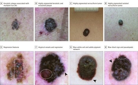 Четыре меланомы, имитирующие себорейный кератоз и требующие тщательной дерматоскопической оценки для постановки правильного диагноза A-D - клинические фотографии. На снимках B и C размеры указаны в миллиметрах. E-H, Дерматоскопические изображения тех же образований. Пигментированные очаги поражения с выраженной гиперкератотической поверхностью, частично препятствующей оцениванию дерматоскопических признаков. Правильное использование иммерсионной жидкости и достаточного освещения может помочь в визуализации и анализе дерматоскопических признаков (сравните G, где не было достаточно иммерсии, и H - правильное изображение, позволяющее обнаружить пигментную сеть [круг]). Наличие тонкой пигментной сети (стрелки в G и H) и глобул (стрелка в F) по периферии очагов поражения, а также сине-черный признак являются основными ключевыми признаками для постановки правильного диагноза. Признаки регрессии (квадрат в E; круг в F) могут служить еще одним поводом для рекомендации полного иссечения образования.
Первоисточник - Carrera C, Segura S, Aguilera P, Scalvenzi M, Longo C, Barreiro A, Broganelli P, Cavicchini S, Llambrich A, Zaballos P, Thomas L, Malvehy J, Puig S, Zalaudek I. Dermoscopic Clues for Diagnosing Melanomas That Resemble Seborrheic Keratosis. JAMA Dermatol. 2017 Jun 1;153(6):544-551.  
https://pubmed.ncbi.nlm.nih.gov/28355453/