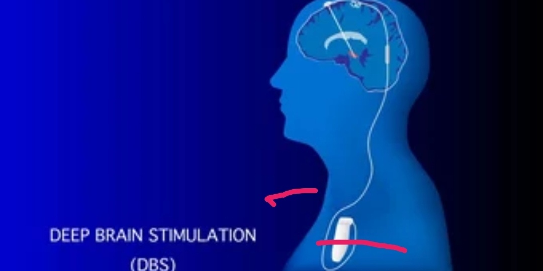 DBS операция