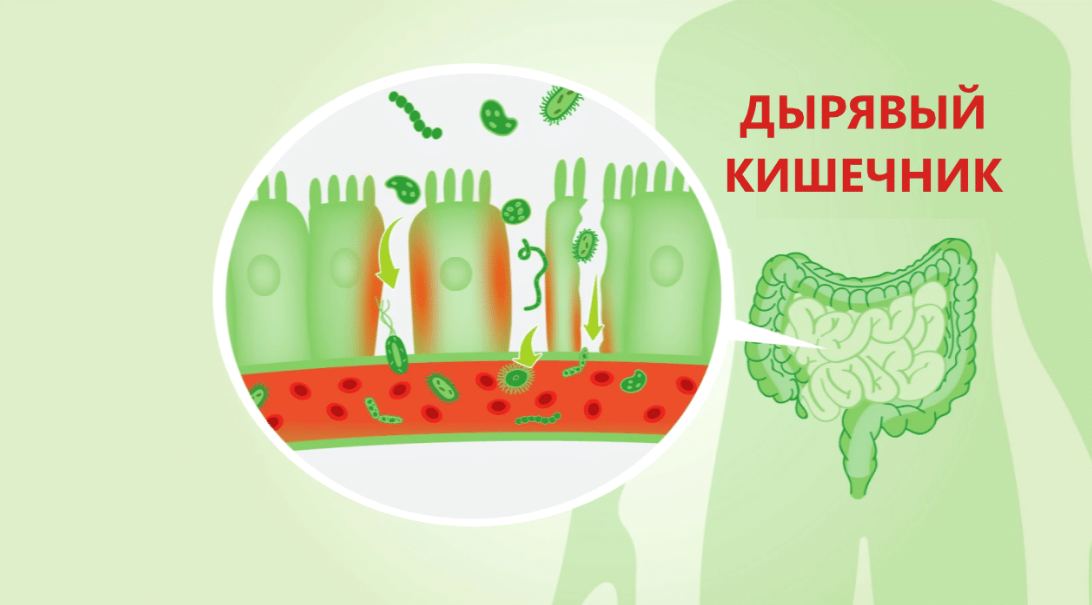 Синдром дырявого кишечника симптомы и лечение. Синдром дырявого кишечника. Дырявый кишечник картинки. Синдром повышенной кишечной проницаемости.