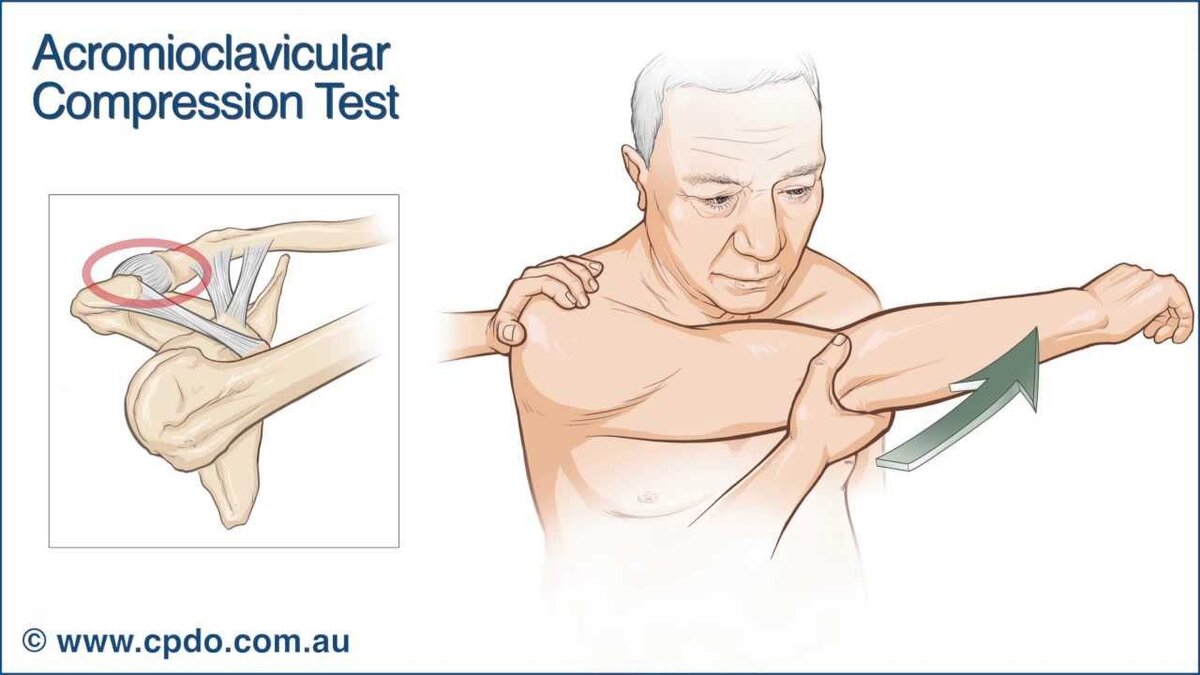 Болезненность при данном движении, указывает на поражение АКС.  