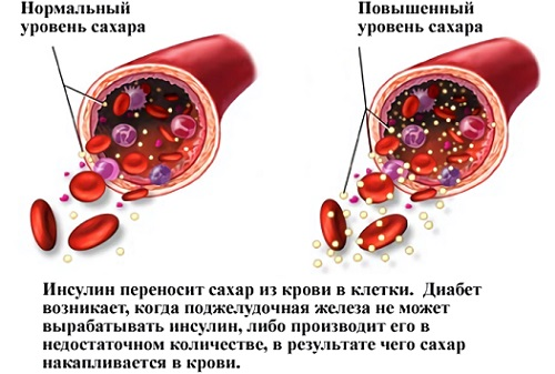 - Сахарный диабет. Профилактика и лечение.