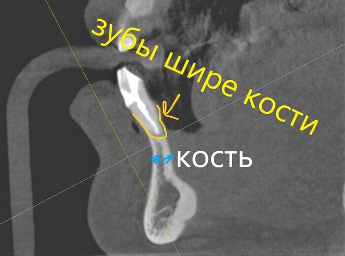 резцы по кости | VK