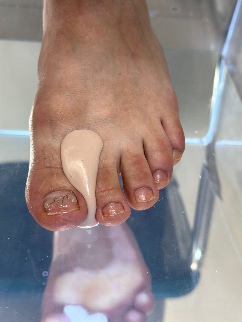 Что из себя представляет изготовленный индивидуальный ортез1 из 3