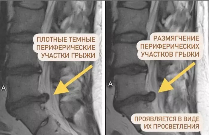 Что такое резорбция грыжи позвоночника. Что такое резорбция грыжи позвоночника