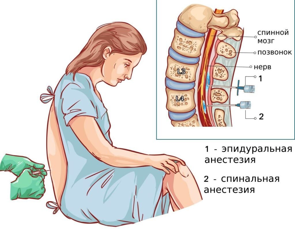 Мне (НЕ) больно! Эпидуральная анестезия в родах.