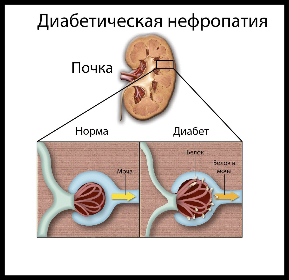 Нормальные почки. Диабетическая уратная нефропатия. Осложнения сахарного диабета нефропатия. Синдром диабетической нефропатии. Диабетическая нефропатия почка.