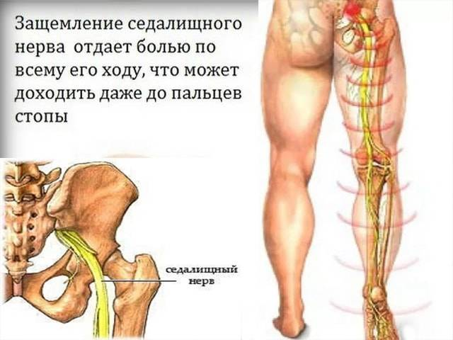 Седалищный нерв защемление симптомы и лечение. Защемление седалищного нерва. Защемило седалищный нерв. Ишиас седалищного нерва симптомы. Защемление седалищного нерва невролог.