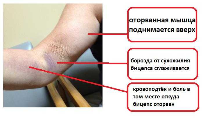 Как выглядит порванная рука