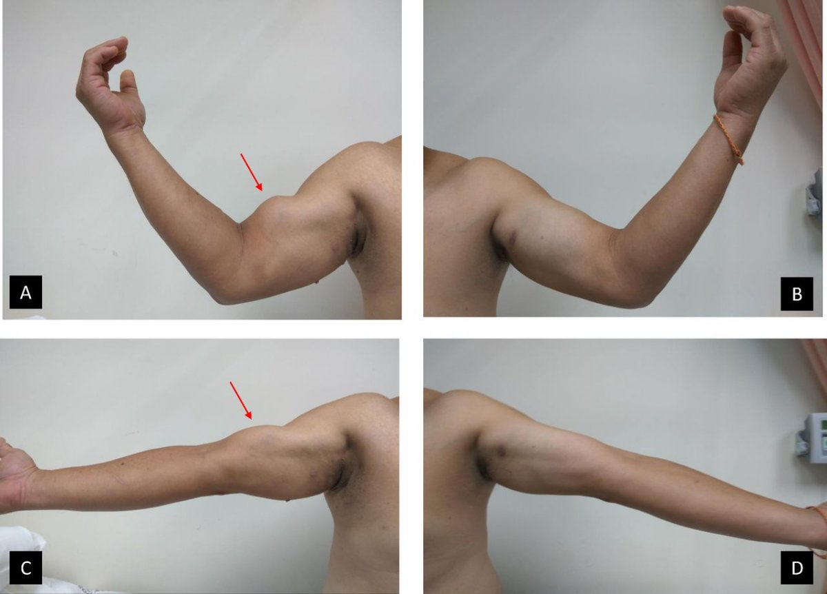 Разрыв дистального сухожилия двуглавой мышцы плеча (разрыв бицепса) | Публикации