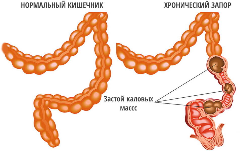 Задержка стула это