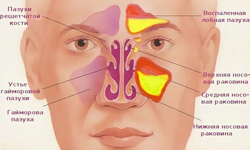Болит нос при простуде. Пазухи носа анатомия синусит. Гайморовы пазухи анатомия гайморит. Строение гайморовых пазух. Пазухи носа анатомия гайморит.