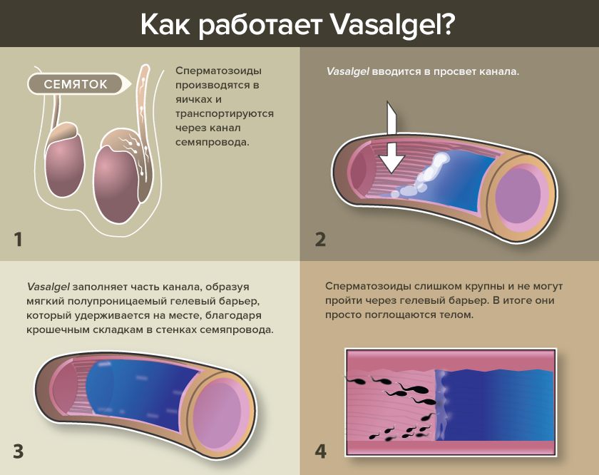 Принцип работы мужского контрацептива Vasalgel.