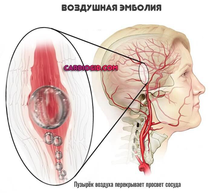 Закупорка головных сосудов. Воздушная эмболия сосудов головного мозга. Воздушная эмболия при травме головы. Воздушная эмболия сосудов может быть осложнением ранения. Воздушная эмболия артерий.