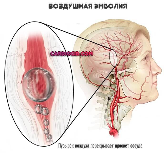 Закупорка сосудов. Воздушная эмболия сосудов. Кессонная болезнь воздушная эмболия. Воздушная эмболия сосудов головного мозга. Воздушная тромбоэмболия.