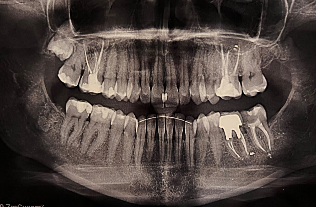 Вот как раз под ретейнером видно снижение уровня кости