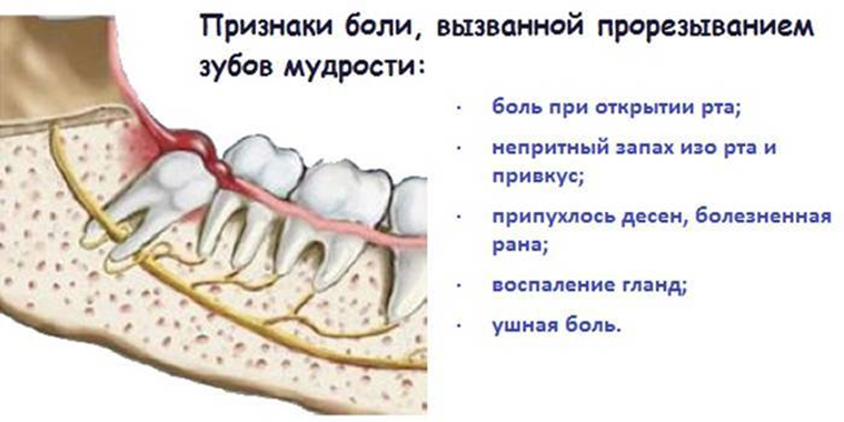 Режется зуб мудрости болит. Режется зуб мудрости Десна. Воспаление и прорезание зуба мудрости.