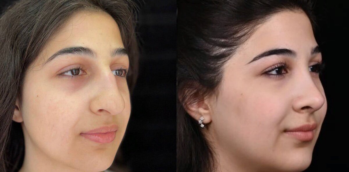 Убрали горбинку, чуть укоротили спинку и уменьшили кончик носа, чтобы исправить искривление перегородки и внешний вид носа. Фото до и после. Фото с сайта хирурга Д.Р. Гришкяна. Имеются противопоказания, требуется консультация специалиста