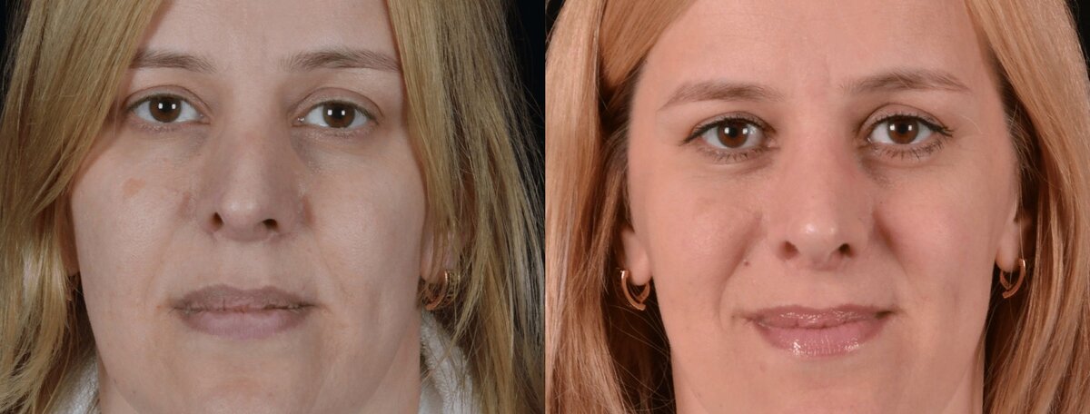 Выровняли нос по центральной вертикальной оси, сделали ровными ноздри, исправили перегородку и носовое дыхание. Фото до и после. Фото с сайта хирурга Д.Р. Гришкяна. Имеются противопоказания, требуется консультация специалиста