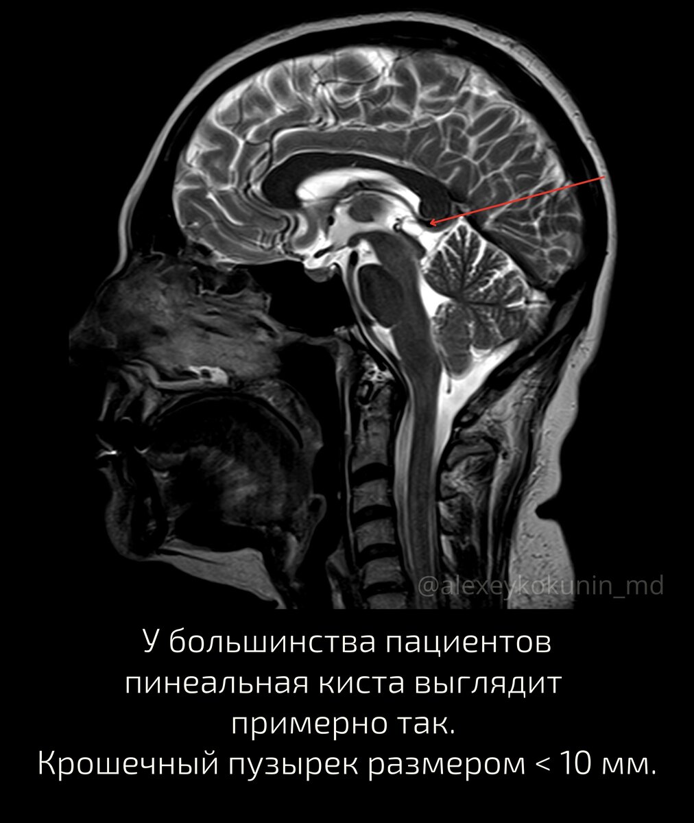 Киста в голове. Стоит ли переживать? | Занимательная диагностика |  Pro.Diagnosi | Дзен