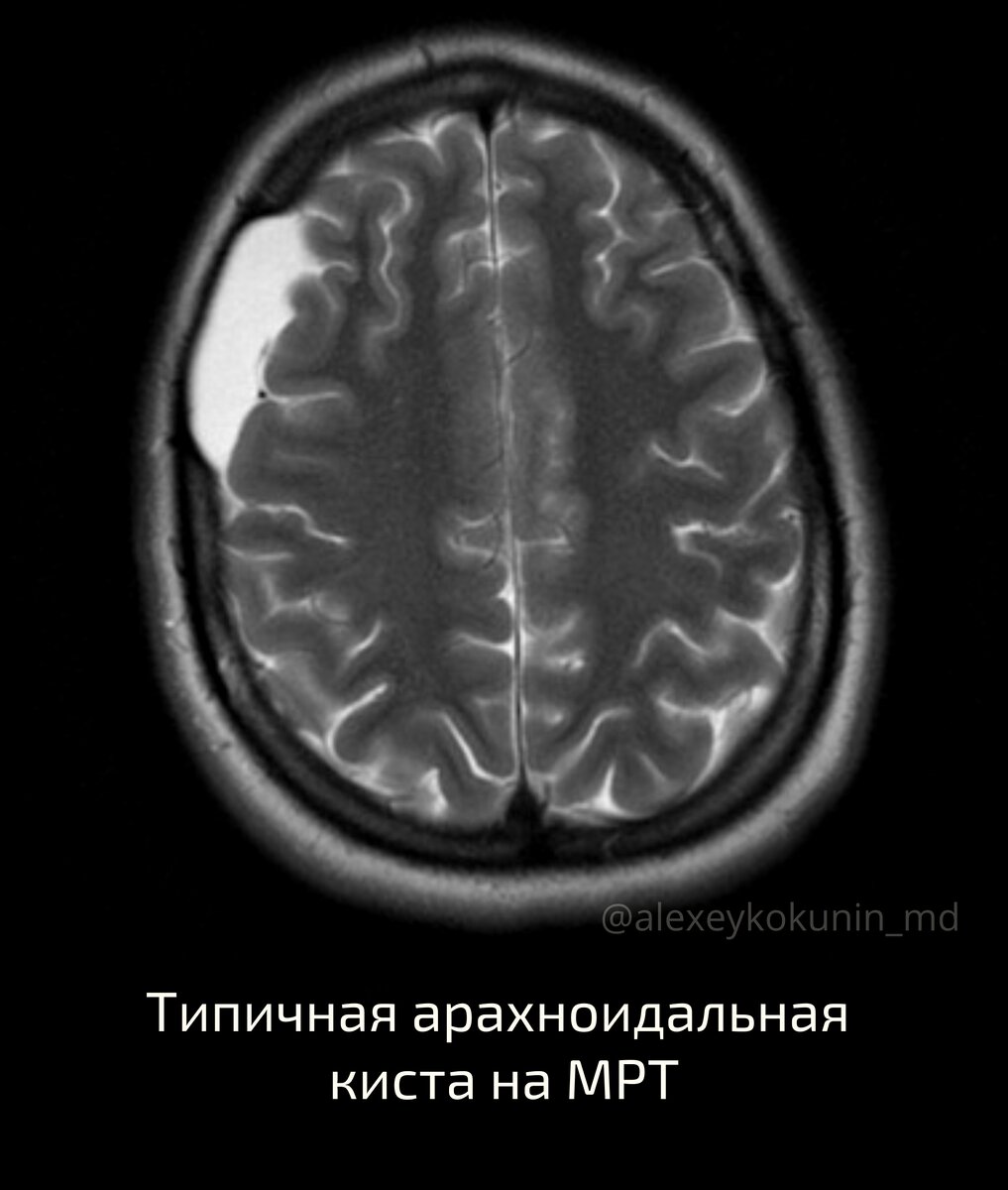 Киста в голове. Стоит ли переживать? | Занимательная диагностика |  Pro.Diagnosi | Дзен