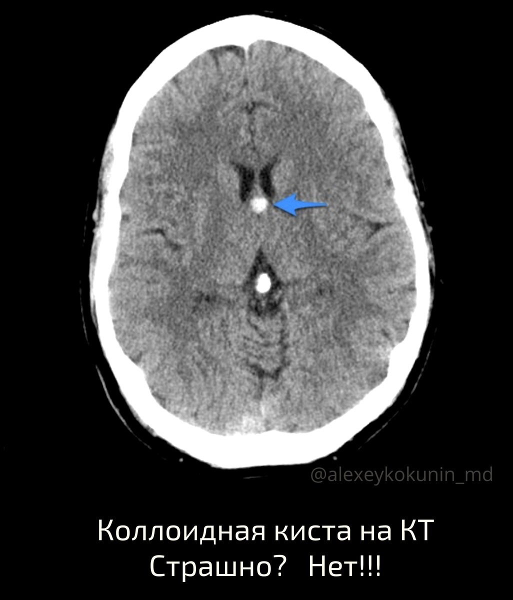 Киста в голове. Стоит ли переживать? | Занимательная диагностика |  Pro.Diagnosi | Дзен