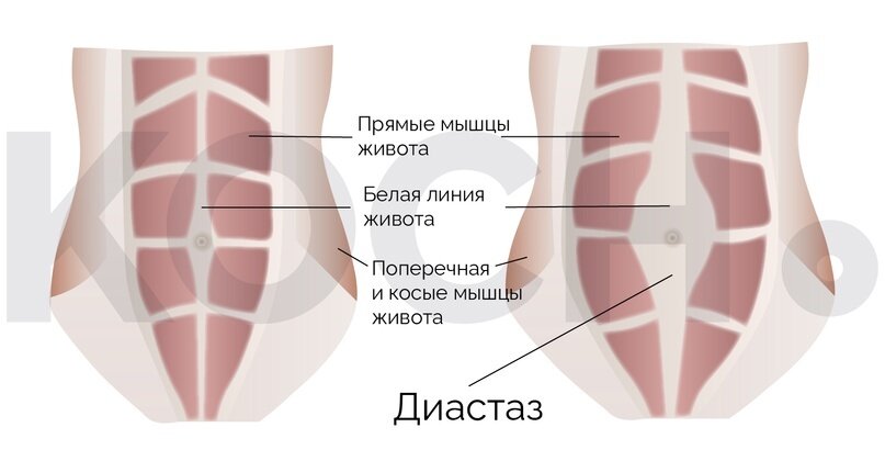 Диастаз мышц белой линии