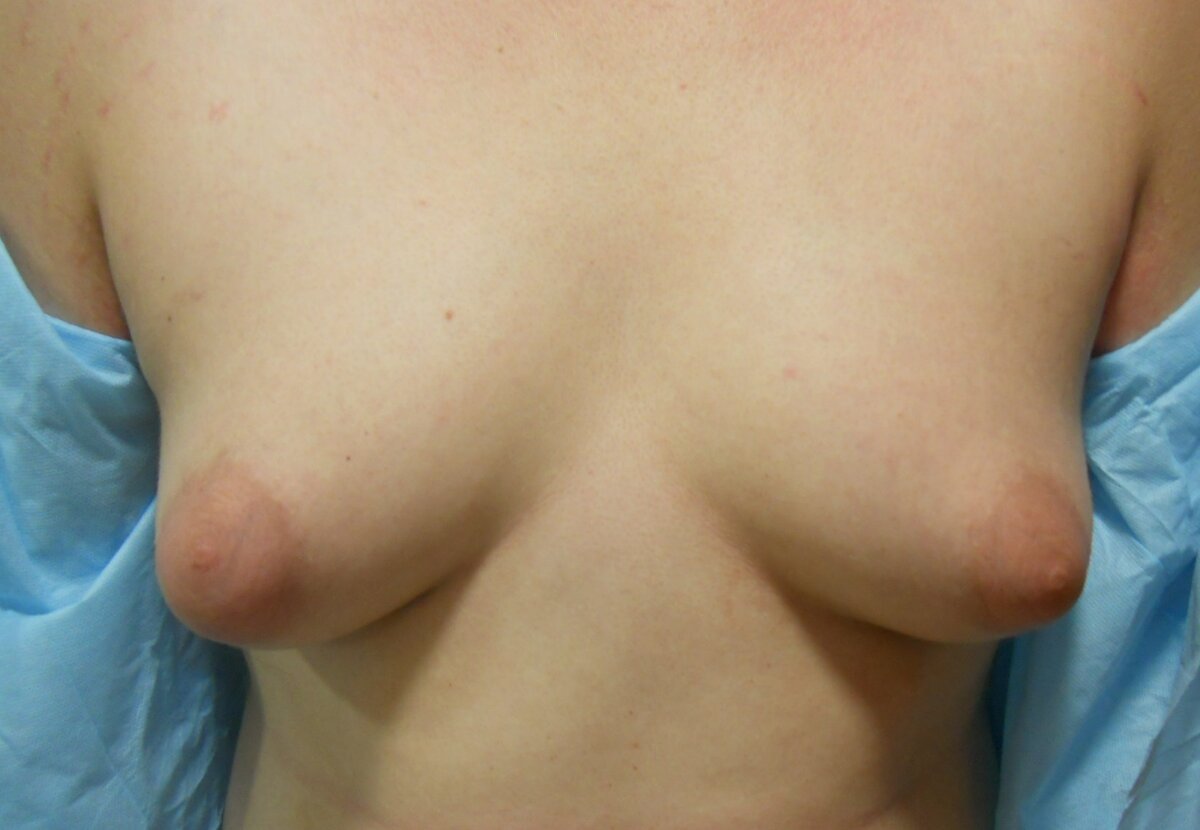 Ложная гинекомастия у мужчины 22 года, нарушения в пубертатном периоде на фоне гормональных изменений. 