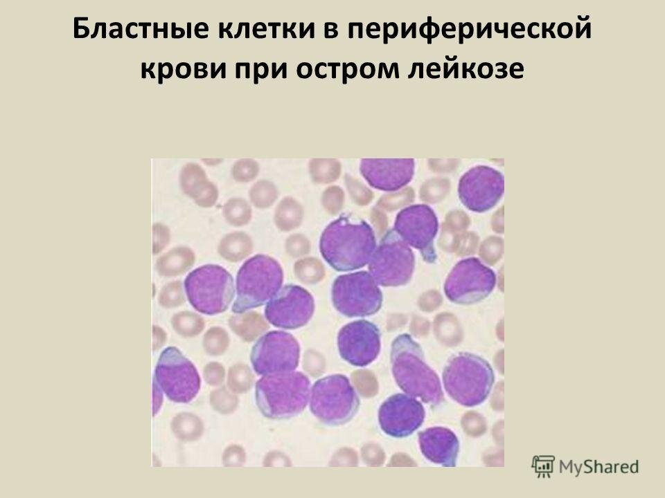 Мозг при остром лейкозе. Бластные клетки в крови при остром лейкозе. Лимфоциты бластные клетки. Бласты в периферической крови при лейкозе. Бластные клетки в крови микроскопия.
