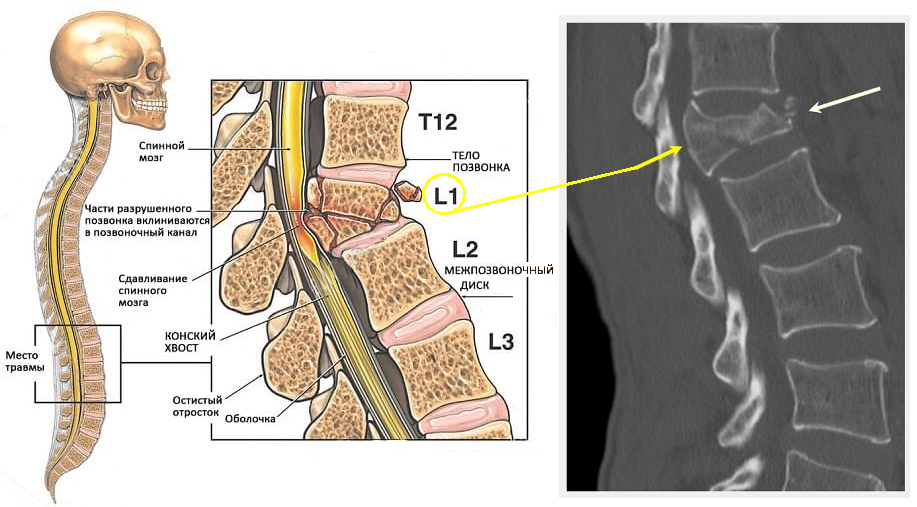 Удаление спинного мозга. Компрессионный перелом позвоночника l1 позвонка. Компрессионный перелом тел l1 l2 l3. Компрессионный перелом позвоночника l1 l2. Компрессионный перелом позвоночника th11-l1.