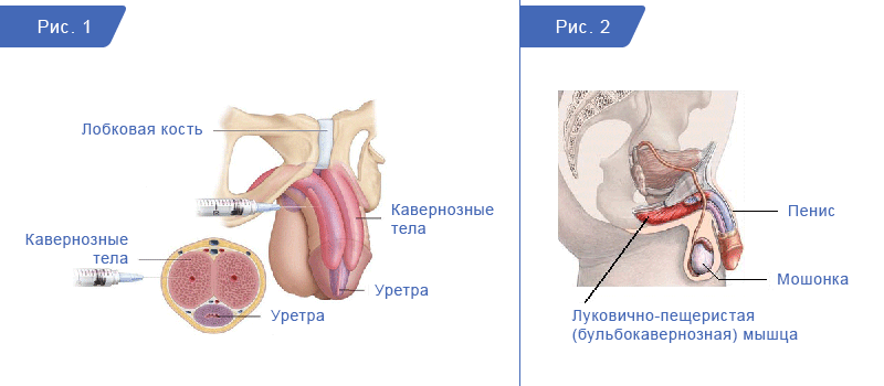 
Рис. 1. Инъекция в кавернозное тело пениса. Рис. 2. Луковично-пещеристая мышца в основании пениса