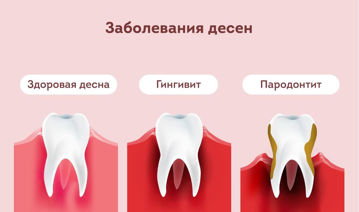 Отчего болят десны и как не остаться без зубов