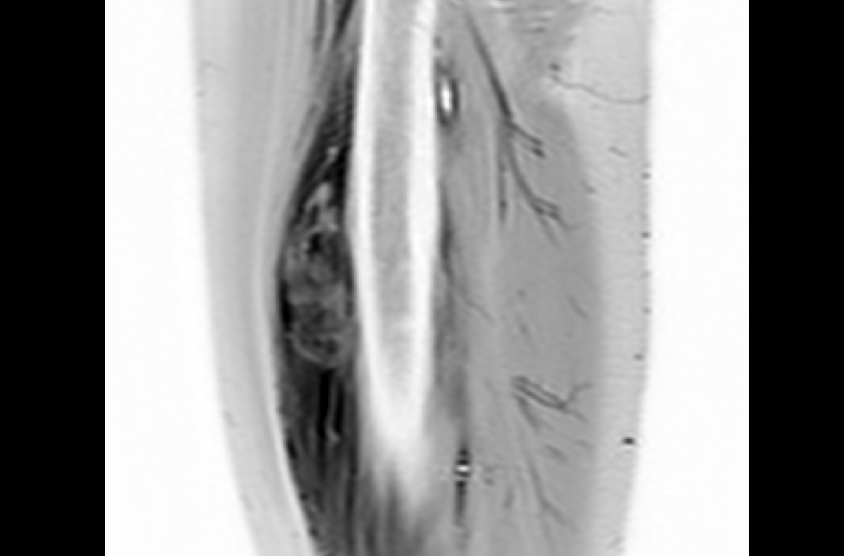 Пациентка 19 лет. Веретеноклеточная опухоль мягких тканей правого бедра ...