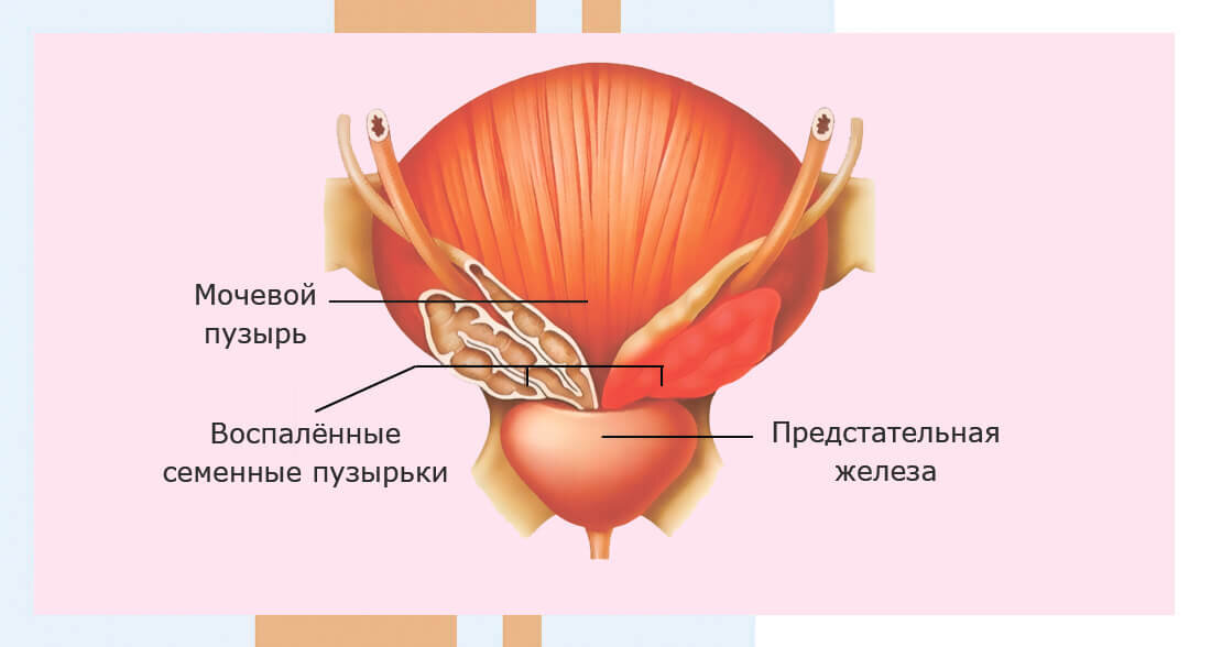 Везикулит у мужчин симптомы. Везикулит сперматоцистит.