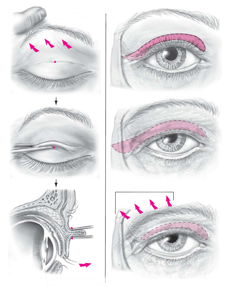 Операция на веки глаз. Пластика блефаропластика верхнего века. Блефаропластика нижних век техника операции. Блефаропластика верхних век нависшее веко. Верхняя блефаропластика нависшее веко.