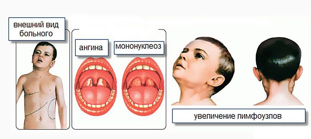 Симптомы инфекционного мононуклеоза. Фото из открытых источников