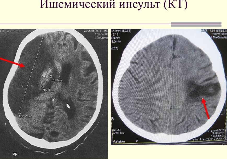 Головной мозг после инсульта. Ишемический инсульт мозга динамика кт снимок. Ишемический инсульт подострый период кт. Кт головного мозга при ишемическом инсульте. Очаг поражения при ишемическом инсульте.