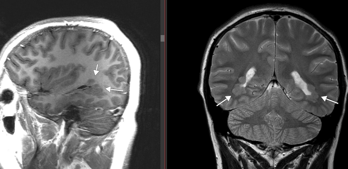 Субэпендимарная гетеротопия серого вещества. Узловая субэпендимальная гетеротопия. Гетеротопия серого вещества мрт. Узловая субэпендимарная гетеротопия. Гетеротопия мрт.