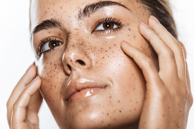 Пигментные пятна на лице