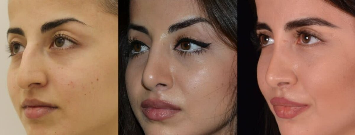 Два года после закрытой ринопластики фото до и после. Фото с сайта хирурга Д.Р.Гришкяна. Имеются противопоказания, требуется консультация специалиста