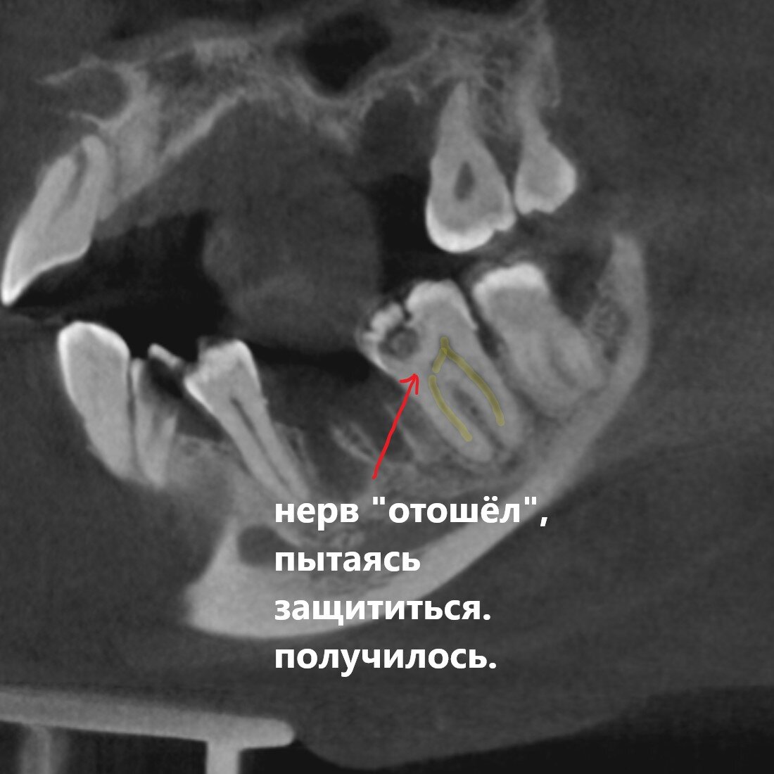 Стрелка указывает на участок защиты.