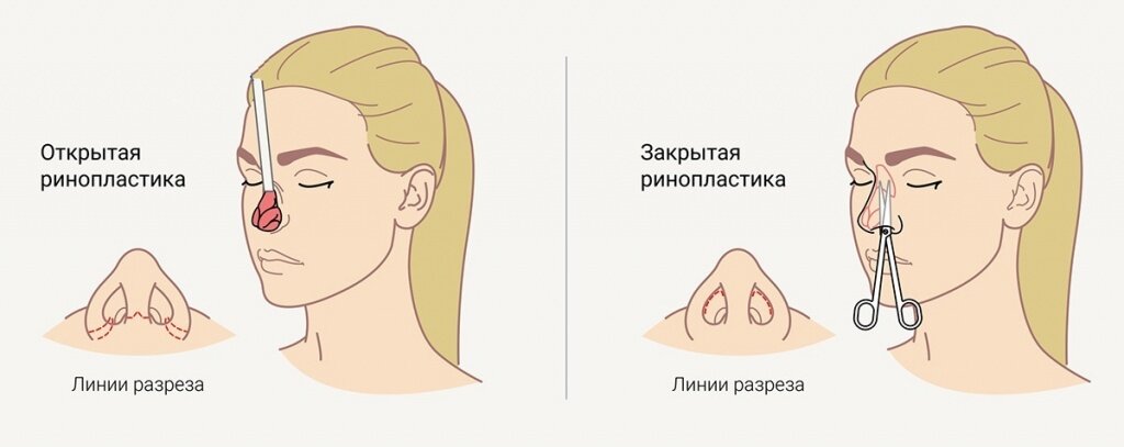 Закрытая операция. Схема проведения ринопластики. Ринопластика ход операции. Закрытая ринопластика схема операции. Открытая и закрытая ринопластика.