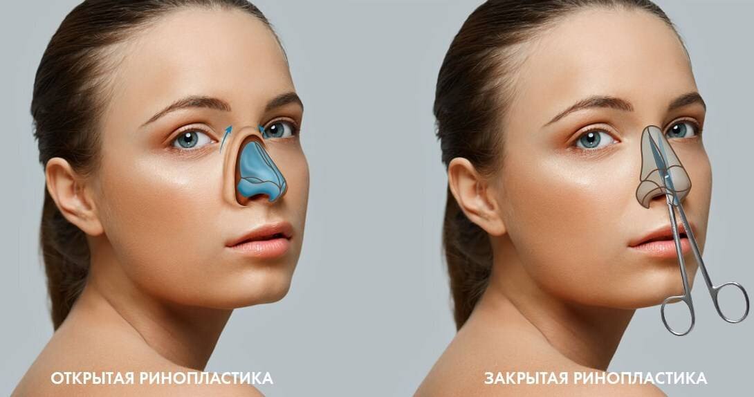 Закрытая ринопластика. Пластика носа. Открытая и закрытая ринопластика. Закрытая ринопластика носа. Компьютерное моделирование ринопластики.